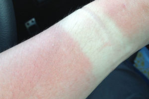 日焼けではなく火傷。登山後に地獄を見ないためには日焼け止め 登山後の日焼けの痛み