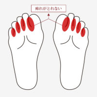 足の指の痺れがとれないモートン病